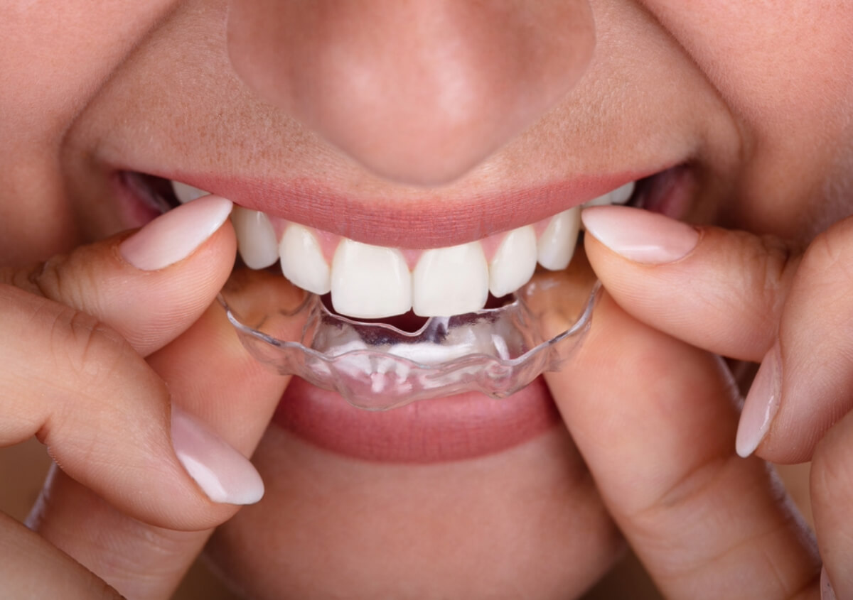 Invisalign for Teeth in Boise ID area