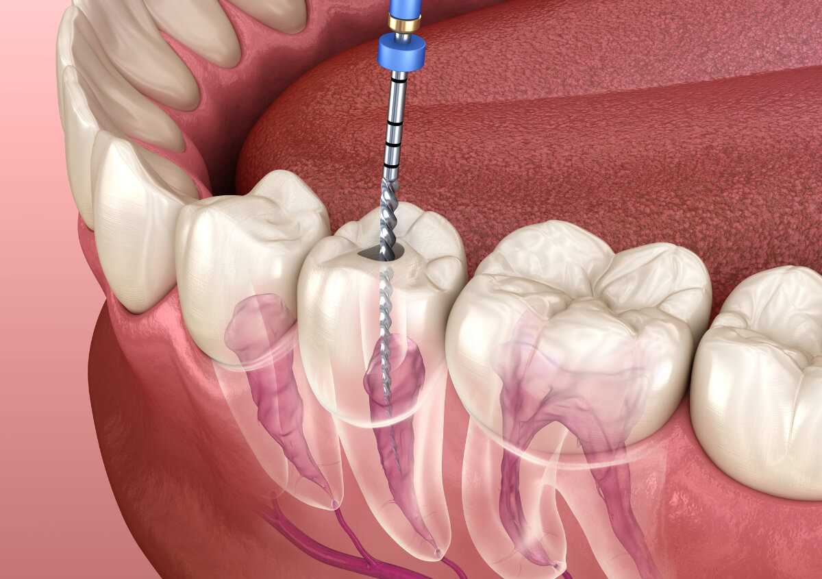 Endodontic Therapy in Boise ID area