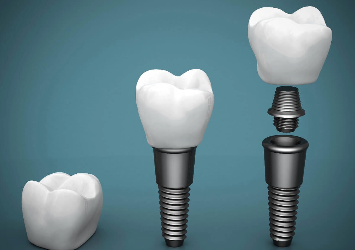 Permanent Tooth Replacement in Boise ID area