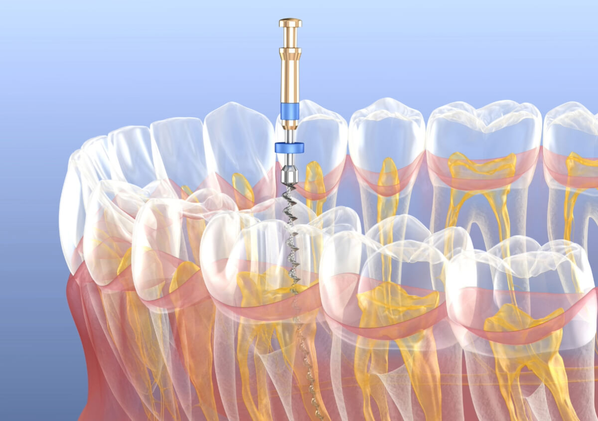 Root Canal with Sedation in Boise ID area